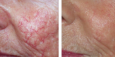 Laser vein treatment before and after